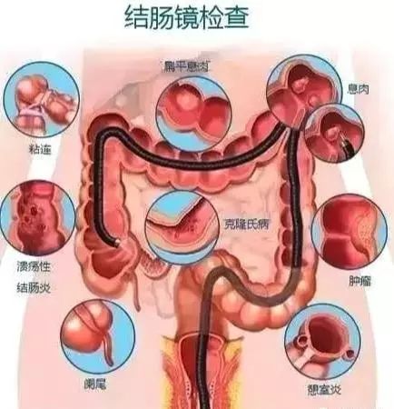 又有一例36岁男子便血一年当痔疮确诊直肠癌