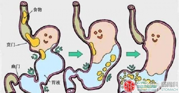 你需要知道的胆汁反流性胃炎症状及平时如何养护