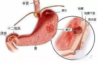 反流性胃炎都有哪些症状？