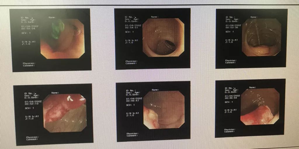 肠镜检查：麻烦一阵子，幸福一辈子