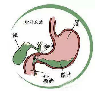 胆汁反流性胃炎发病有五大因素