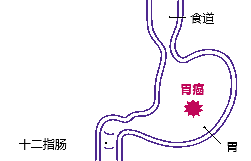 全国无幽日——幽门螺杆菌全科普