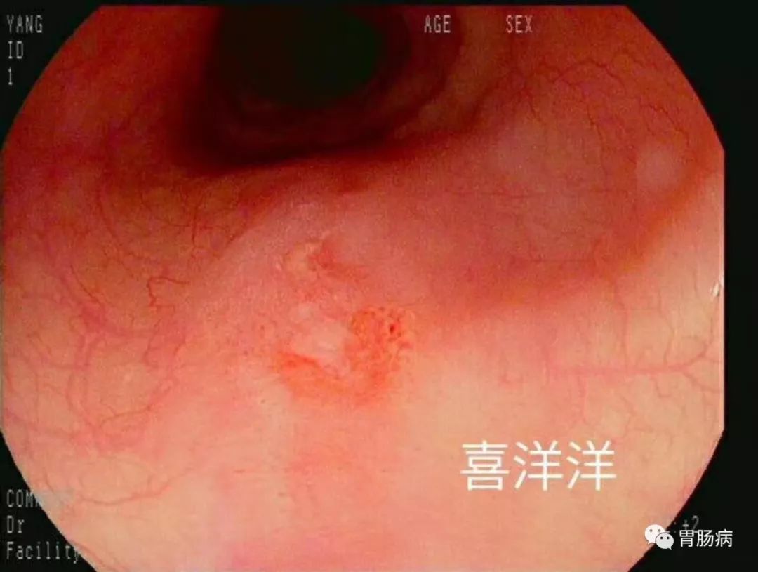 意外做了个胃镜，竟然发现个早癌