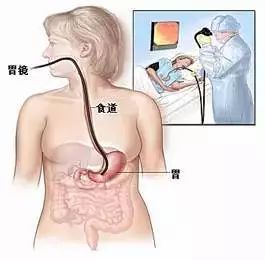 四五十岁，真的该做胃肠镜检查了！