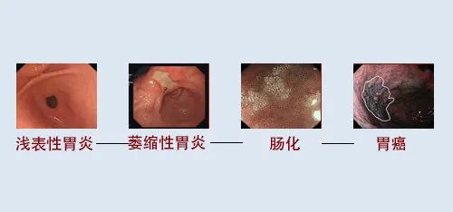 浅表性胃炎，还需要治疗吗？