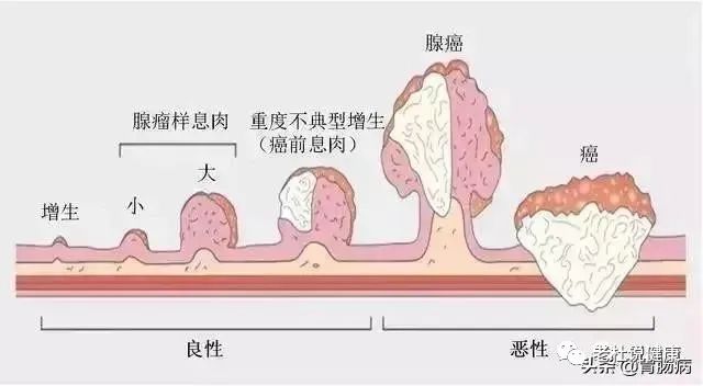 第一次做肠镜，她就查出肠癌——年过40，这个检查不能少