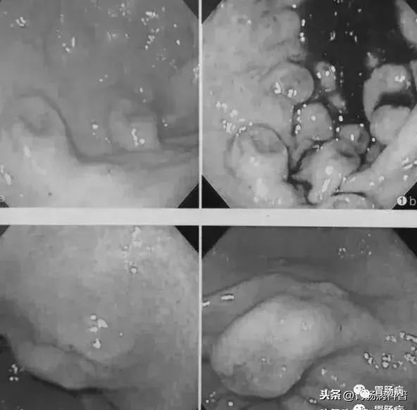 这种“糜烂性胃炎”有癌变风险！