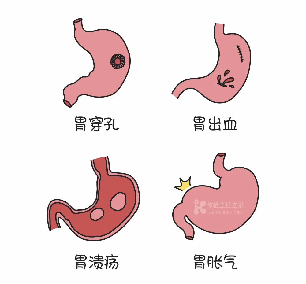 科普案例丨“我28岁，入职体检，查出了胃癌”