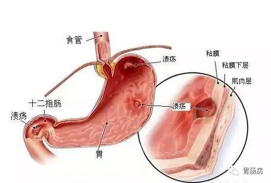 大夫，我的胃“烂了“，还能活多久？——糜烂性胃炎