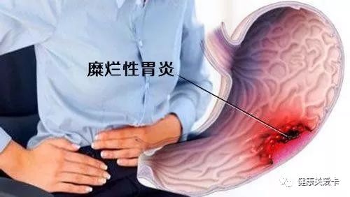 糜烂性胃炎有哪些症状？患者在这三个阶段的症状 你知道了吗