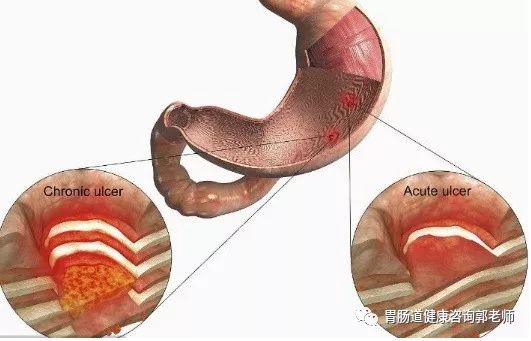 糜烂性胃炎多久做一次胃镜比较好？不及时治疗，后果严重！