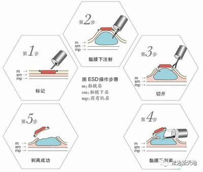 科普 | 认清胃肠镜，早做早放心！