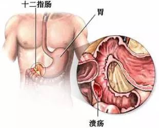 胃溃疡的病因及饮食调理