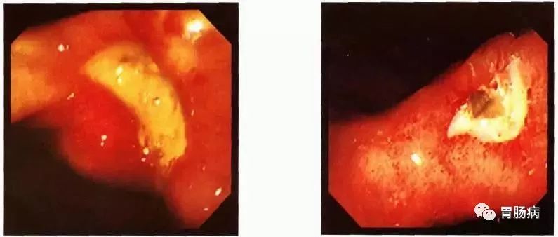 胃溃疡的内镜下表现及分期
