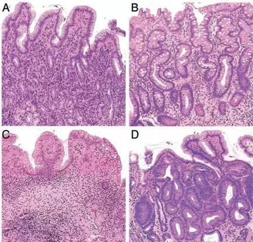 关于萎缩性胃炎，你想知道的全在这里！