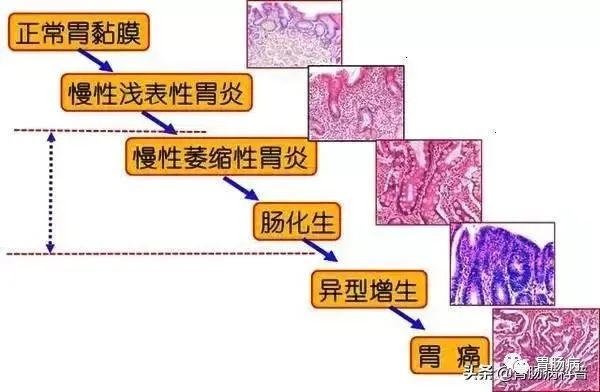 关于萎缩性胃炎，你想知道的全在这里！