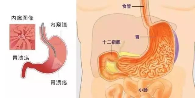 胃镜检查前，需要注意什么？该如何准备？