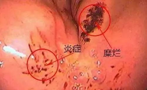 胃糜烂真的是胃“烂”了吗？会癌变吗？