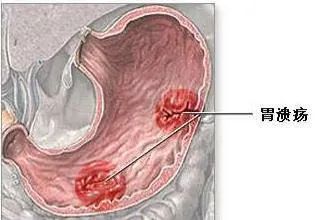 胃溃疡是怎么形成的？跟这些因素有关，快来了解下