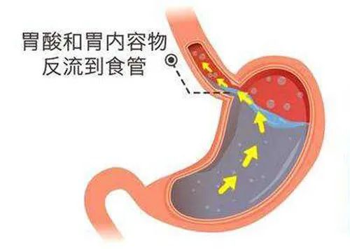 反流性食管炎严重吗？如何预防？医生：做好这三点，它会远离你