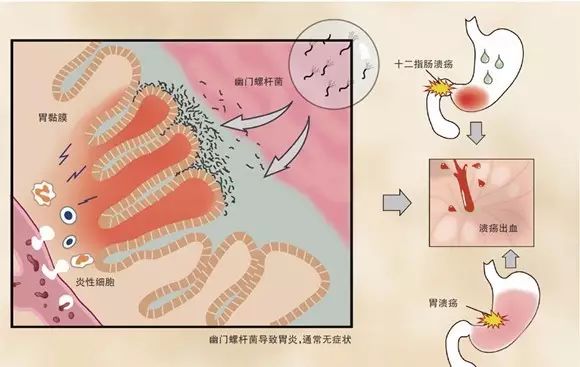 嘴里有异味不敢说话？不怪嘴怪胃！