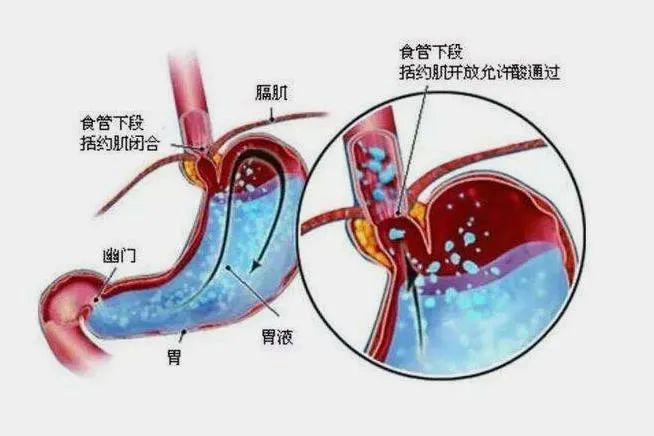 反酸、烧心、嗳气......胃食管反流是什么原因？