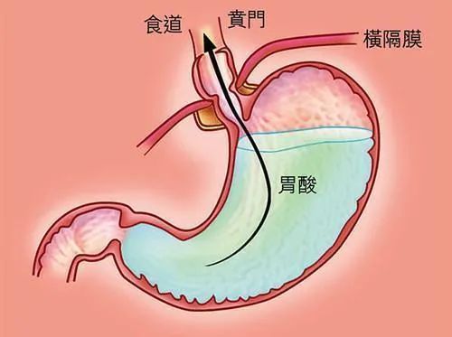 胃酸过多，什么该吃，什么不该吃，吃什么能缓解呢？