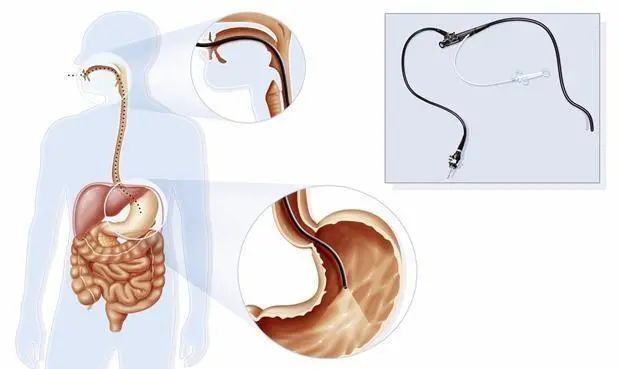 有慢性胃病的人，多久做一次胃镜检查合适？多数人可能不是很清楚