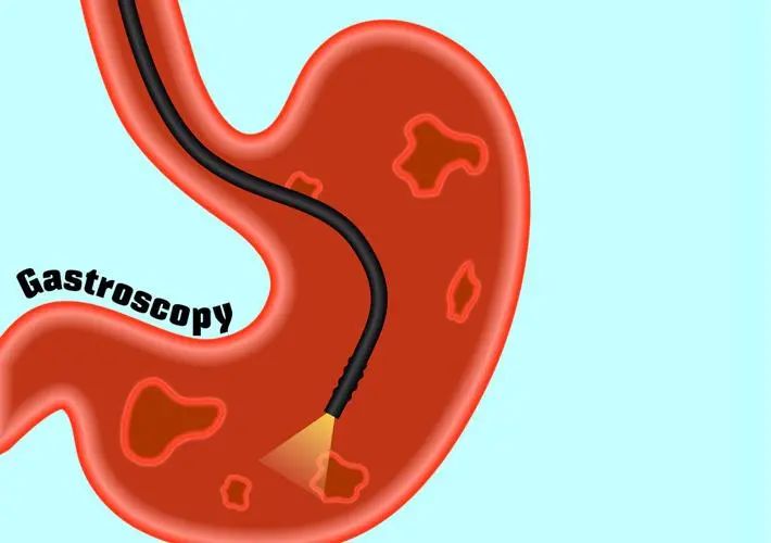 一步到“胃”的胃镜检查会伤身体吗？