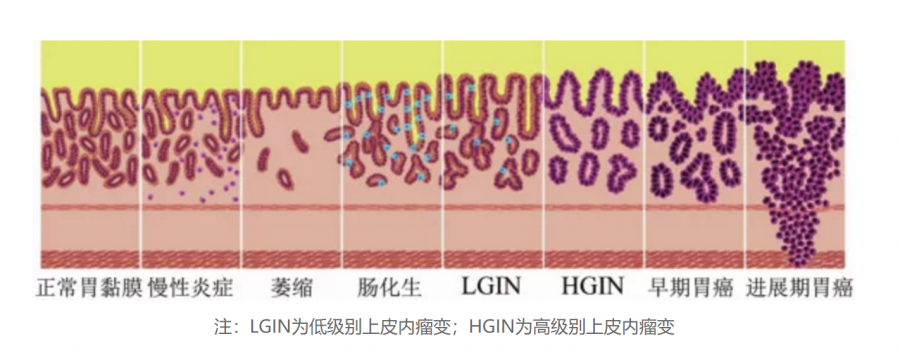 胃镜病理报告提示肠化？小心“胃”也来玩“画皮”