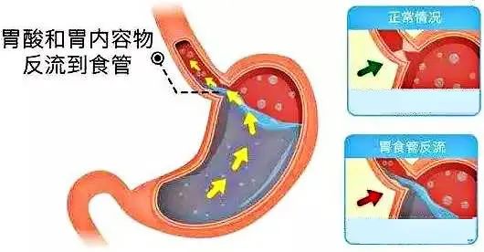 反酸、烧心、胸骨疼？5招教你缓解这些症状!