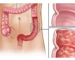 直肠炎的5个表现，6大病因！