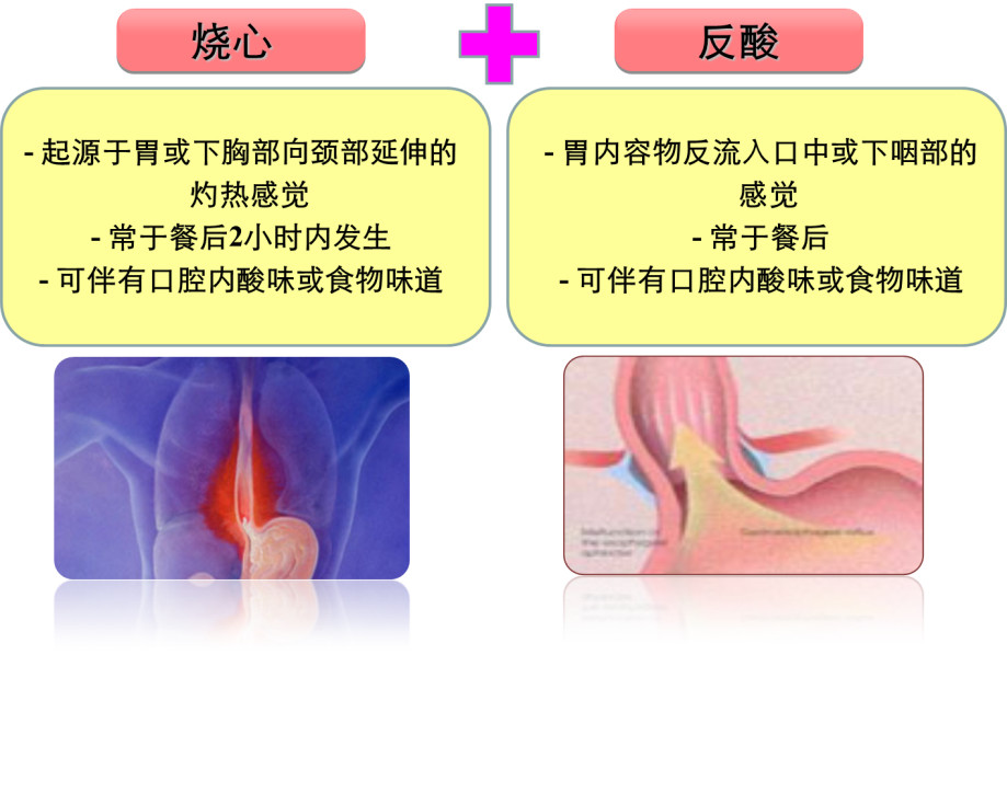 总是烧心 你可能已经被这种疾病缠上了！