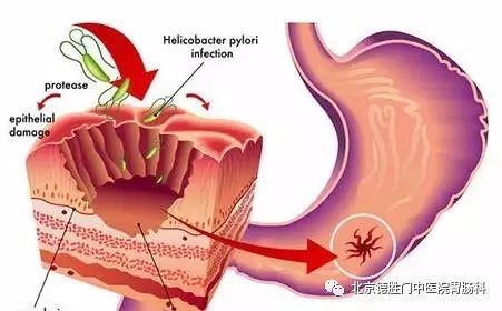 不治不养，萎缩性胃炎三个月就会癌变？