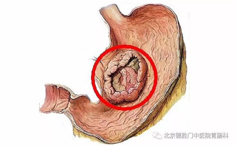 慢性萎缩性胃炎，这样做，阻断癌变！