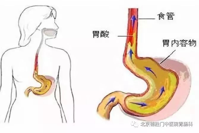 胃食管反流的人要注意，这8个行为加重疾病！