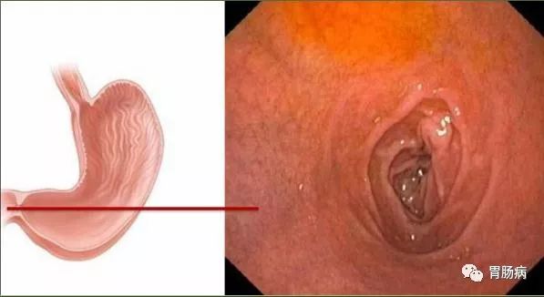 今日科普 | 胃镜检查全过程——你以为只能检查胃吗？