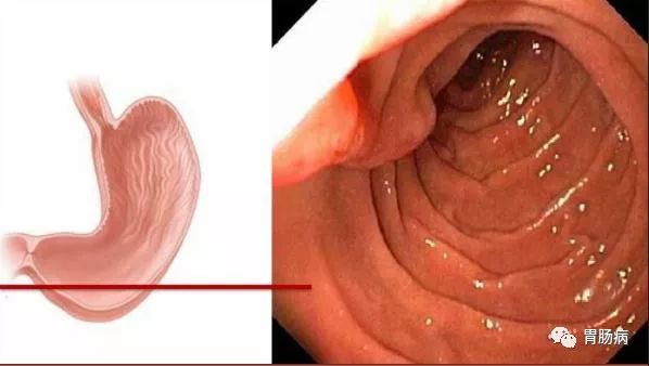 今日科普 | 胃镜检查全过程——你以为只能检查胃吗？