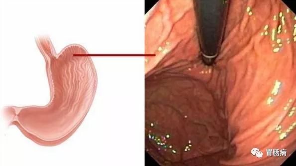 今日科普 | 胃镜检查全过程——你以为只能检查胃吗？