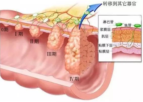 今日科普 | 从息肉到大肠癌，仅仅是一次肠镜的距离！