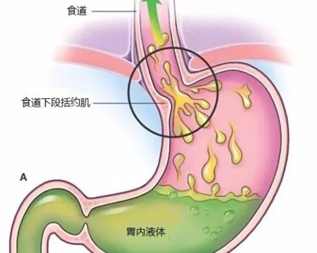 诱发胃食管反流的九大因素，你中了几个？