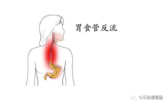 胃食管反流病，要戒掉四种行为，3类食物