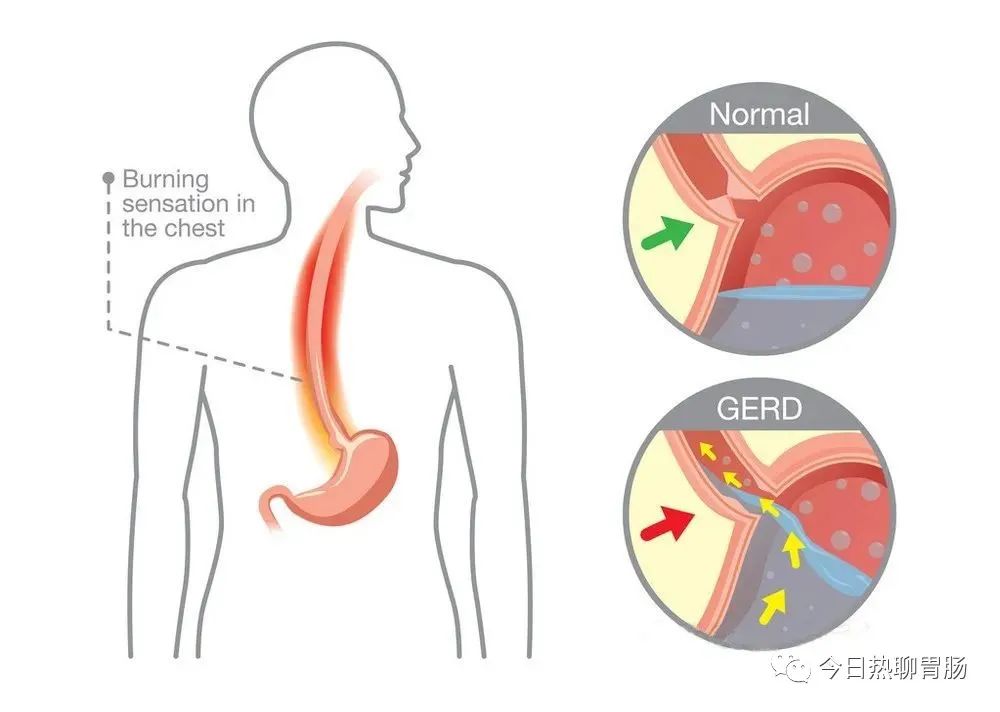 胃食管反流病，要戒掉四种行为，3类食物