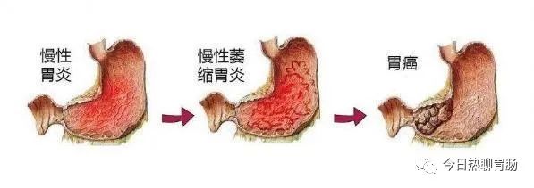 萎缩性胃炎会癌变？胃癌前疾病=胃癌？别杞人忧天