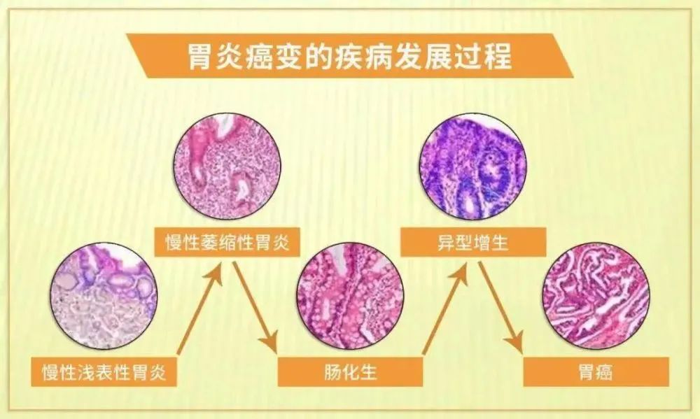 慢性萎缩性胃炎就是胃变小了吗？严重吗？