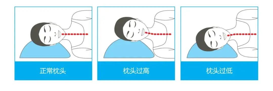 胃“门”关不紧导致反酸、烧心