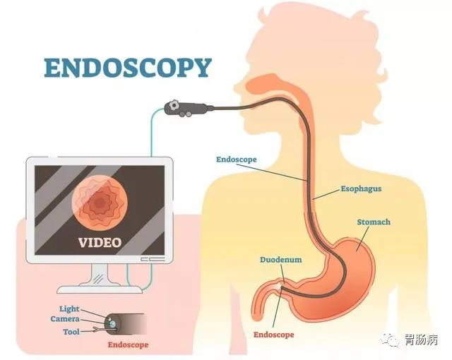 为什么说胃肠镜是救命的检查？90%的疾病都集中在消化道！