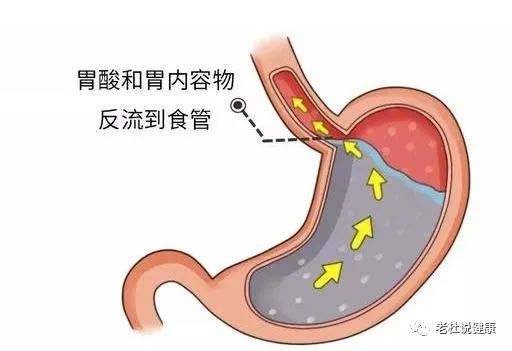 别把“烧心”不当病，发作起来能要命——谈谈胃食管反流症