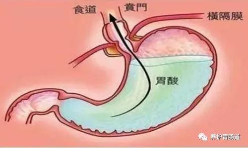 胃痛近3年，检查发现胆汁反流性胃炎，怎么办？