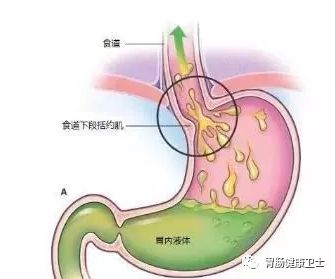 关于反流性胃炎，你必须知道这几点！